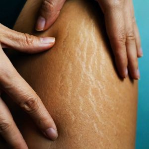 Before And After Photos Of Female Hip Stretch Marks On Woman's L