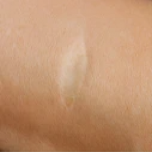 before-scar-e1663071756717.png