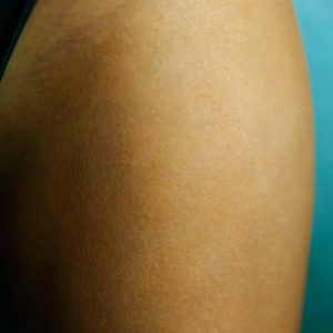 Before And After Photos Of Female Hip Stretch Marks On Woman's L